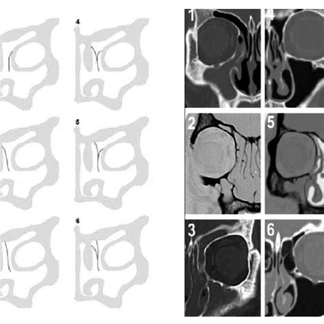 (Left) A coronal CT scan illustrating the agger nasi cell (*) and... | Download Scientific Diagram