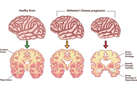 The Stages of Dementia | Page 3 of 5 | HealthWasp