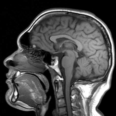 Progressive supra-nuclear palsy | Eurorad