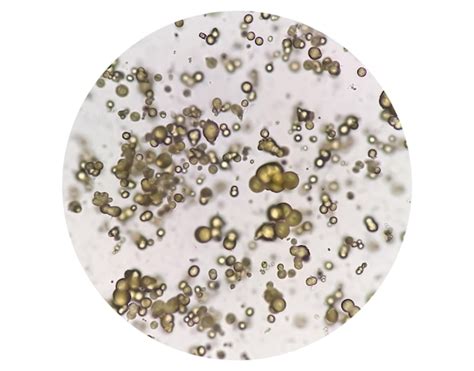 Premium Photo | Microscopic image of urinalysis. abnormal urine exam ...