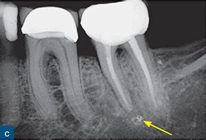 Vertical Root Fractures | Pocket Dentistry