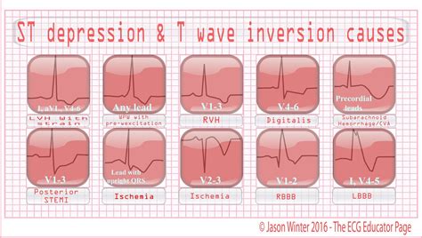 ECG Educator Blog : ST depression & T wave inversion causes