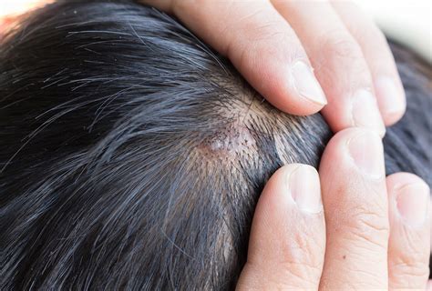 How to Treat Scalp Sores - eMediHealth