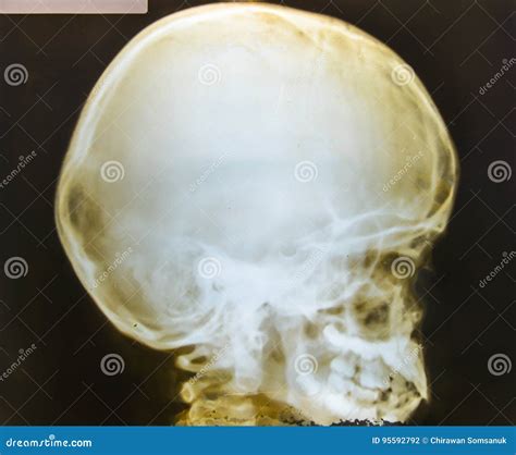 Skull X-Ray of Human Medical Stock Photo - Image of injury, patient ...