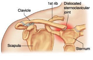 Sarah, when researching Subluxed Clavicle, I was only finding dislocation of the clavicle from ...