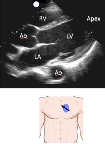 Point of Care Echocardiography: Parasternal Long Axis