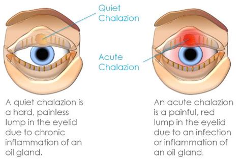 Meibomian Gland Cyst