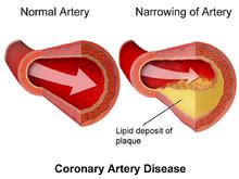 Coronary artery disease - Wikipedia