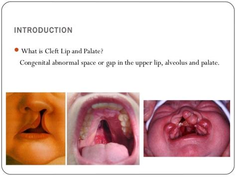 Cleftlipandpalate