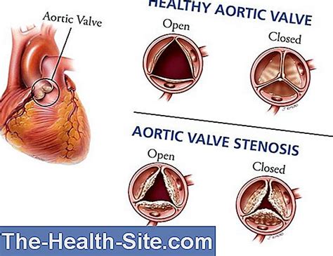 Aortic Valve Stenosis: Causes, Warning Signs, Treatment 💊 Scientific ...