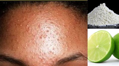 How to Get Rid of Small Bumps on Face & Forehead | Simple Home Remedy in 2020 | Small bumps on ...