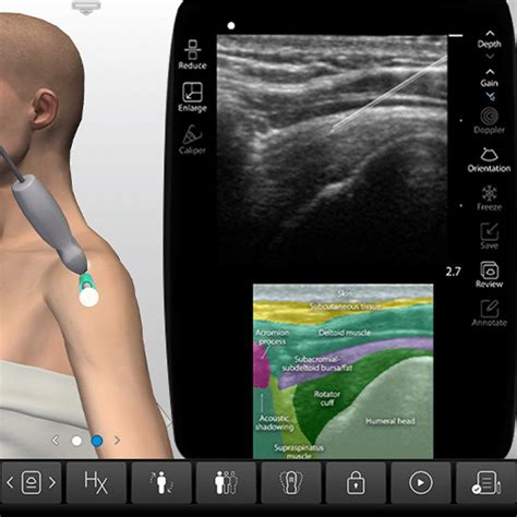 Subacromial Injection - Subacromial Shoulder Injection Ultrasound