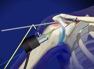 Diagnosis and Surgery of Shoulder Impingement Syndrome | Joint-surgeon.com