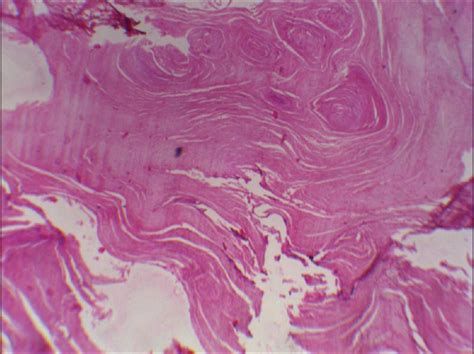 Cornu Cutaneum Histology