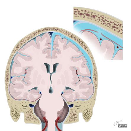 Subdural hygroma | Radiology Reference Article | Radiopaedia.org