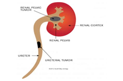 Cancer - renal pelvis or ureter as related to Cancer - Pictures