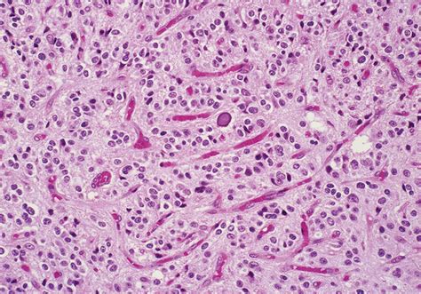 Oligodenodroglioma Histopathology showing a delicate "chicken-wire" network of branching ...