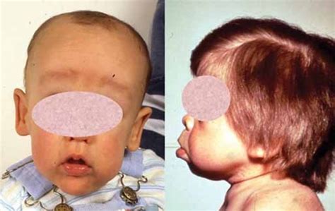 Mucopolysaccharidosis type II: MedlinePlus Genetics