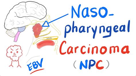 Nasopharyngeal Carcinoma Npc