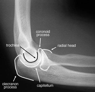 Radiographic Anatomy of the Skeleton: Elbow -- Lateral View, Labelled | Medical anatomy, Medical ...