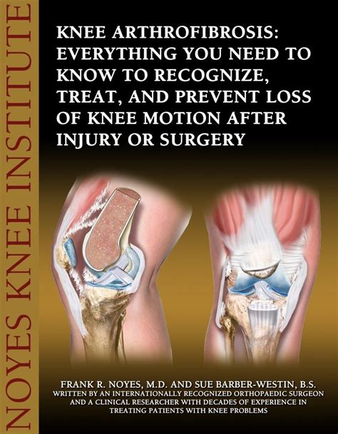 Knee Arthrofibrosis Center - The Noyes Knee Institute