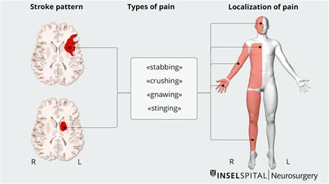 Central post stroke pain | Neurosurgery Inselspital Bern