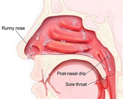 Nasal Congestion - Meaning, Causes, Symptoms and Treatment