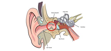 Guide to Surfer’s Ear – Cleanline Surf