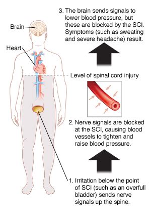 Autonomic Dysreflexia | Saint Luke's Health System