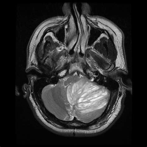 Lhermitte Duclos disease | Radiology Case | Radiopaedia.org | Radiology ...