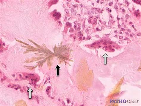 Histology Gout Tophus, Detail Image - DocCheck