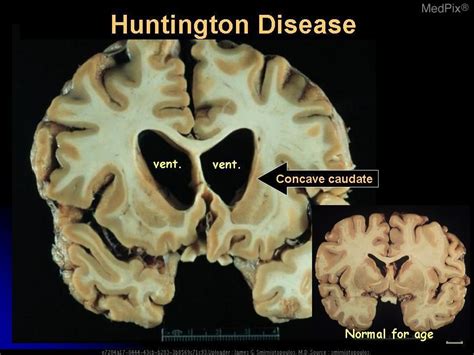 Huntington's chorea - Eddie Hawk