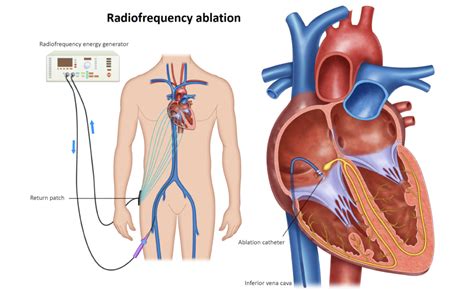 SVT Ablation - Melbourne Heart Group