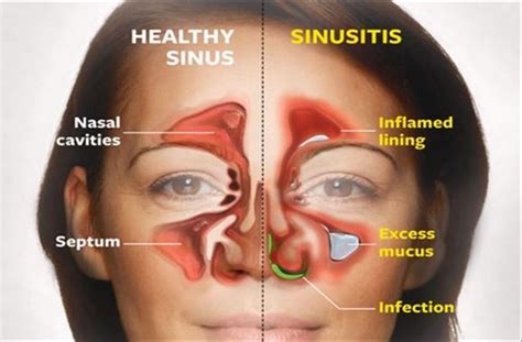 Kill Sinus Infection in 20 Seconds with This Simple Method and This Common Household Ingr ...