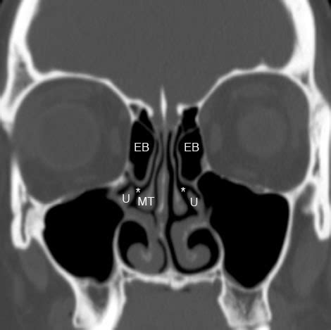 Ethmoid Sinus: Normal Anatomy & Variants