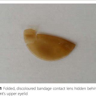 (PDF) Folded bandage contact lens retention in a patient with bilateral ...