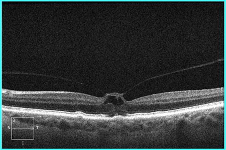 RetinaCare | Vitreomacular traction and small macular hole successfully ...