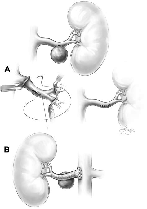 Renal artery aneurysms - Journal of Vascular Surgery