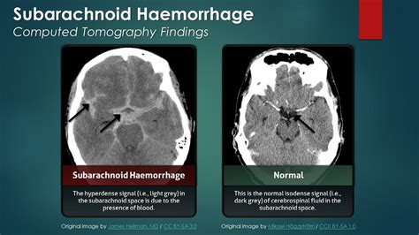 Subarachnoid Hemorrhage (SAH): Computed Tomography Scan Findings - YouTube