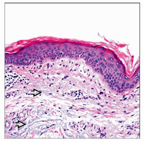 Acantholytic Cells