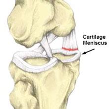 Coronary Ligament Sprain - Symptoms, Causes, Treatment & rehabilitation