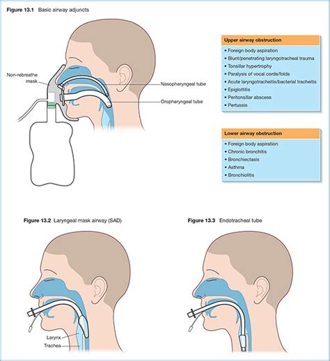 Pediatric Nasopharyngeal Airway Size Chart