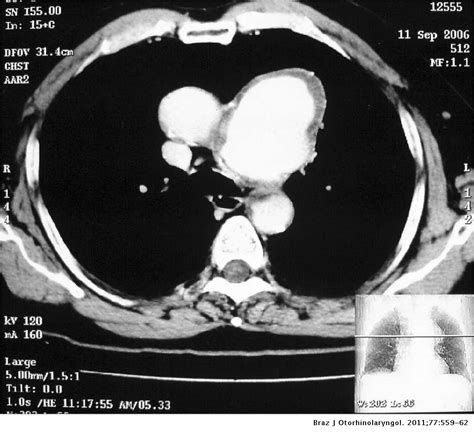 Ortner's syndrome: - case series and literature review | Brazilian Journal of ...