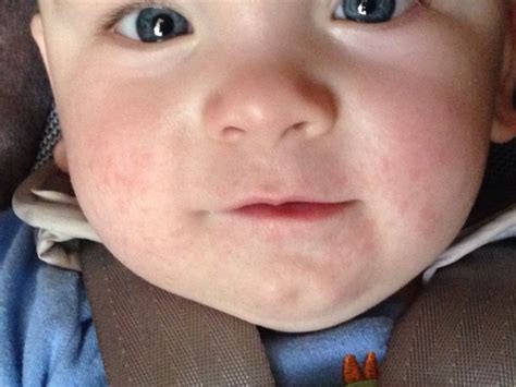 Does this look like food allergy rash? (Pic) - BabyCenter