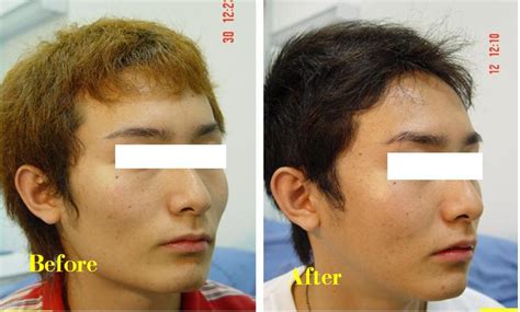 Plastic Surgery Photos: Cheek Bone Reduction Before And After Photos