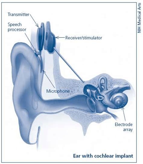 1 Bionic ear: Cochlear implant 42 | Download Scientific Diagram