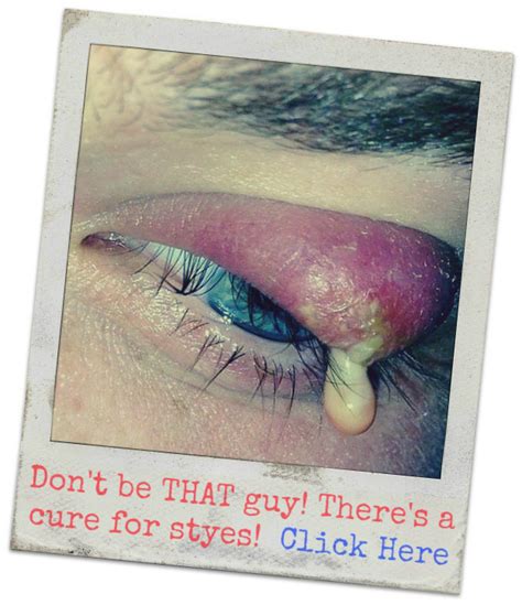 Best Stye Medicine: Antibiotics, OTC or Home Remedies?