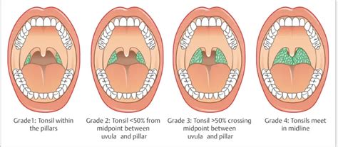 Tonsillitis Grading