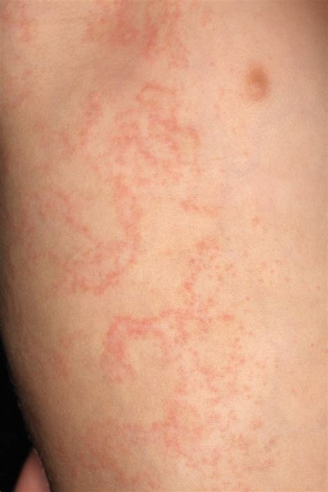 Erythematous Papules and Plaques on the Flank of a Child | MDedge Dermatology