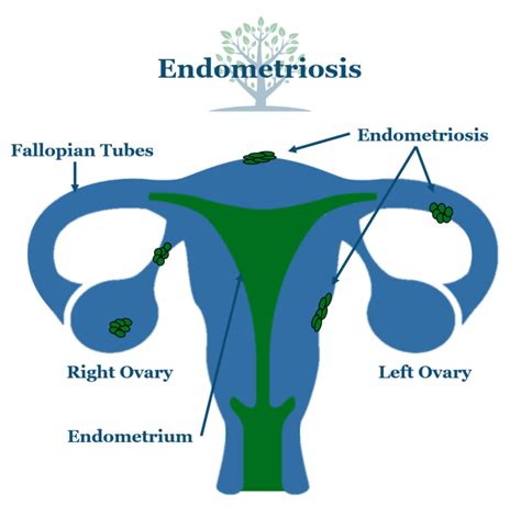 Endometriosis | Generation Next Fertility NYC